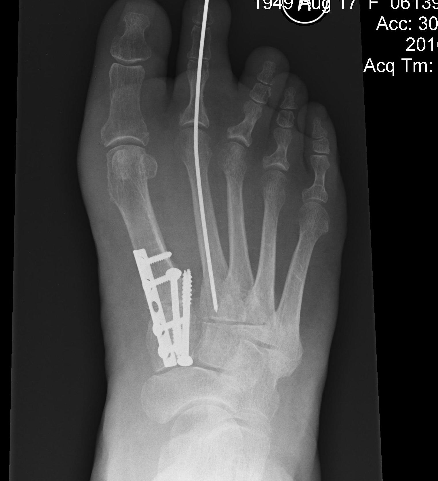 Hallux Valgus Proximal Osteotomy and Lapidus